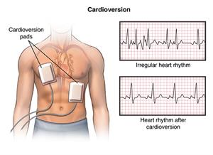 Cardioversion, showing cardioversion pads, and read-outs of irregular heart rhythm and heart rhythm after cardioversion