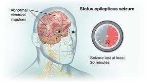 Status Epilepticus Seizure Status Epilepticus Seizure