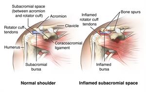 Shoulder Bursitis