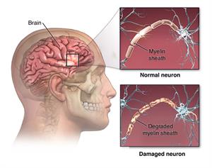 Side view of brain with inset of normal neuron and a neuron with damaged myelin sheath. 