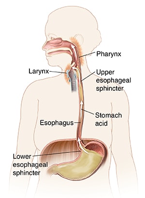 Outline of person showing mouth, esophagus, and stomach. Arrows show stomach acid flowing up esophagus to irritate back of throat.