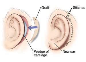 Reconstruction of ear, showing placement of wedge of cartilage, skin graft, and stitches behind ear.