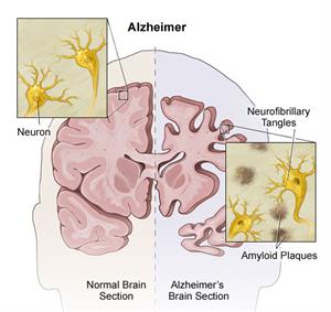 Alzheimer anatomy Alzheimer anatomy