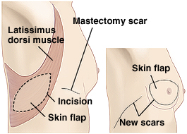 Side view of female chest showing LD flap breast reconstruction.