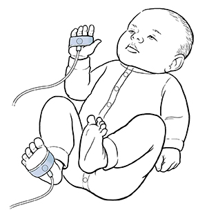 Baby with oxygen sensors wrapped around right hand and right foot.